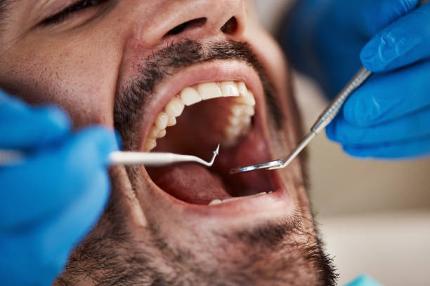 Best Emergency Wisdom Teeth Removal in Lewistown, MT
